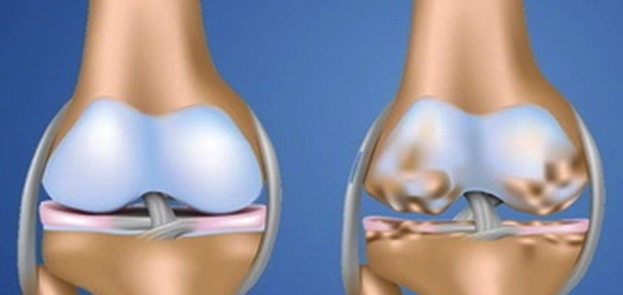 5 BÀI TẬP HỖ TRỢ ĐIỀU TRỊ THOÁI HÓA KHỚP GỐI HIỆU QUẢ TẠI NHÀ